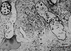 F,76y. | unspecified sarcoma (myocarcoma v.s.) - calf